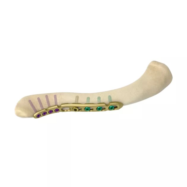 MR-VA Anterior Clavicle Locking Plate