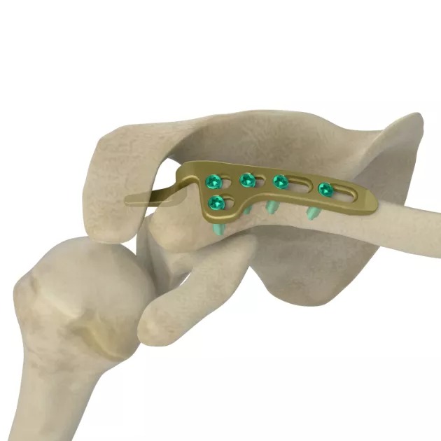 LCP Clavicle Hook Plate