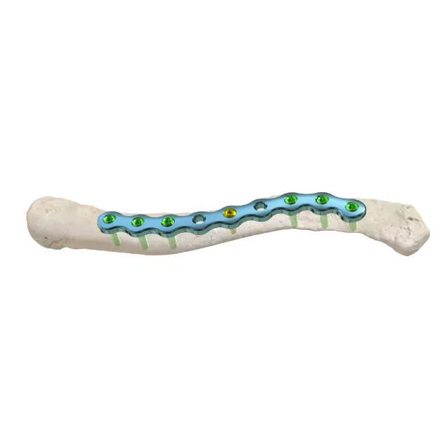 Clavicle Reconstruction Locking Plate