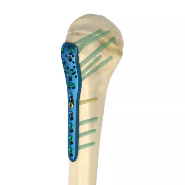 LCP Proximal Humeral Plate