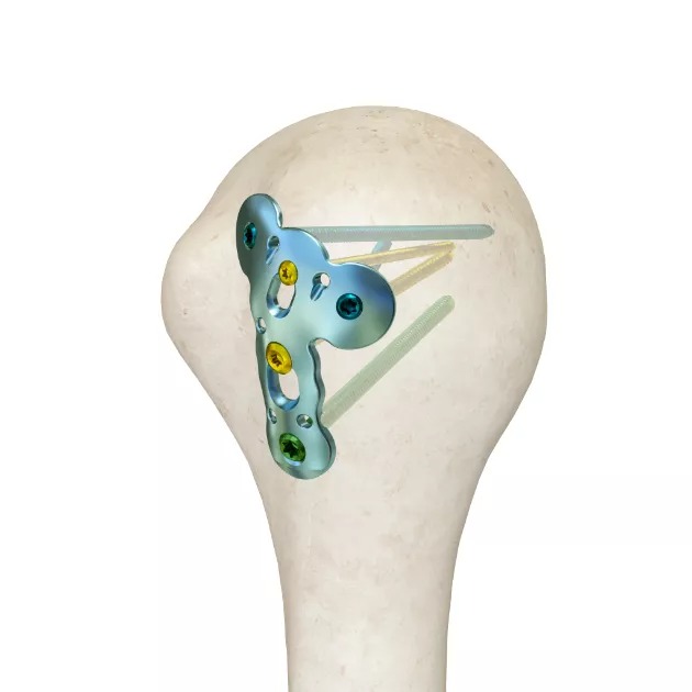 MR-Humeral Greater Tuberosity LCP