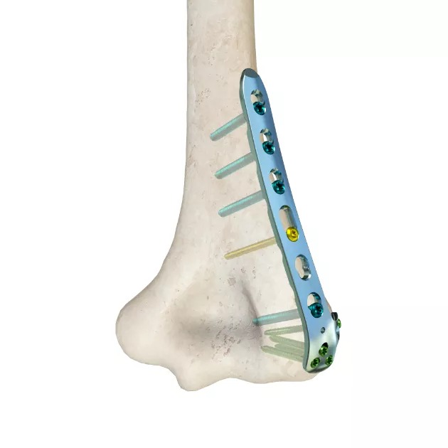 LCP Distal Lateral Humeral Plate