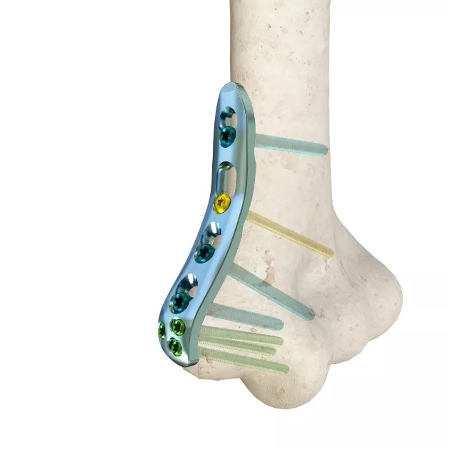 LCP Distal Medial Humeral Plate