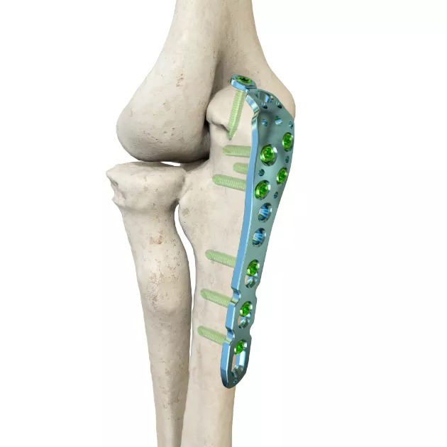 LCP Olecranon Plate