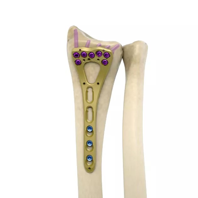 MR-VA Volar Distal Radius Locking Plate