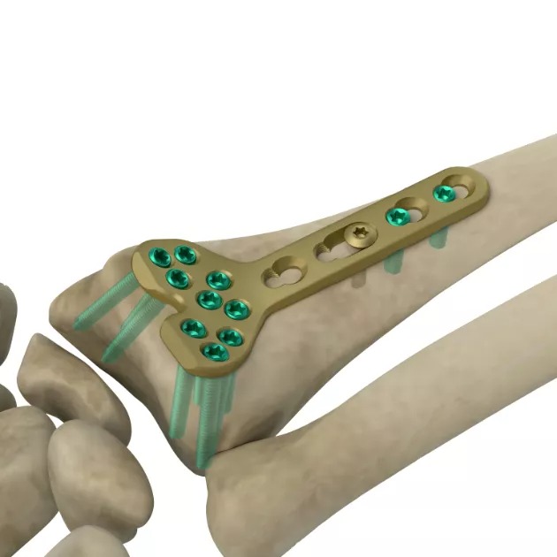 LCP Volar Column Distal Radius Plate 2.4