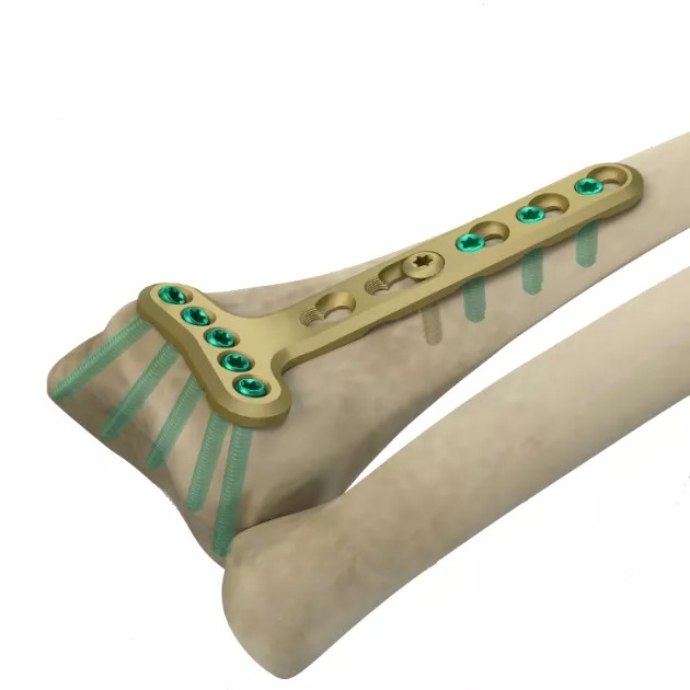 LCP Dia-Meta Volar Distal Radius Plate