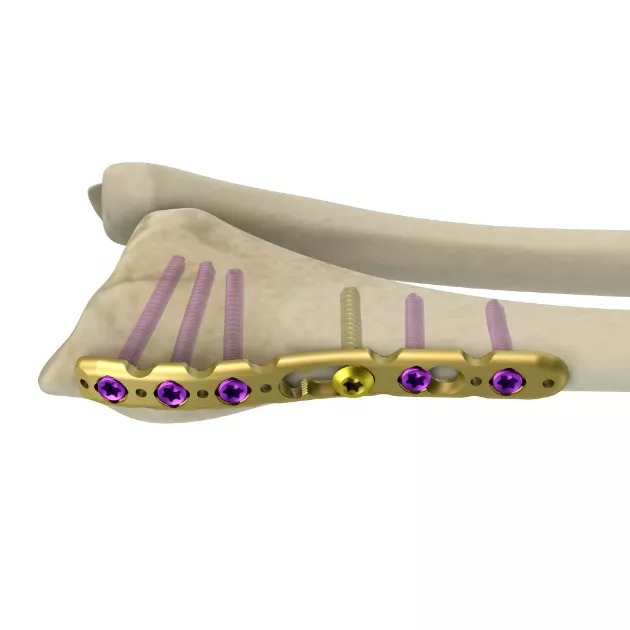 MR-VA Distal Radius L Plate 2.4,oblique&MR-VA Distal Radius Locking Plate