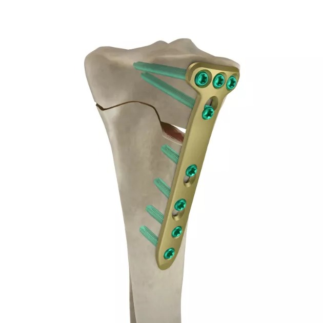 MR-OSTO Medial High Tibial Plate
