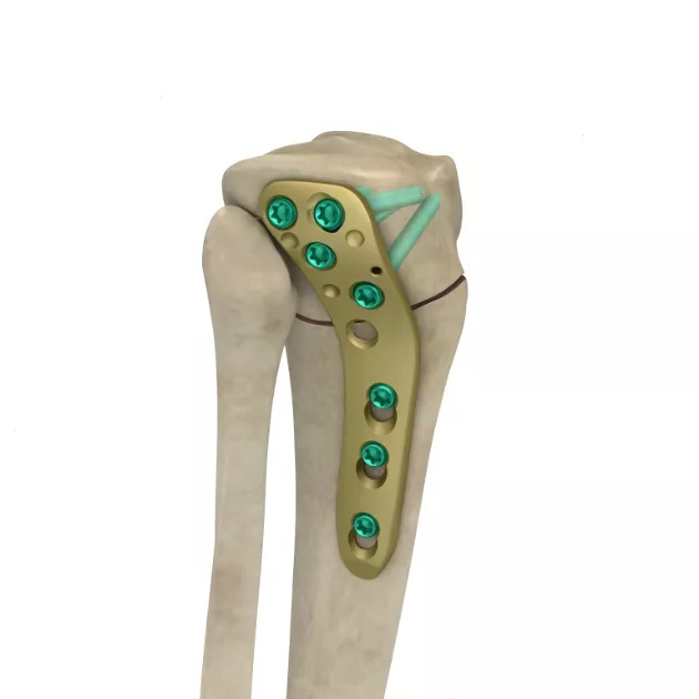 MR-OSTO Lateral High Tibial Plate