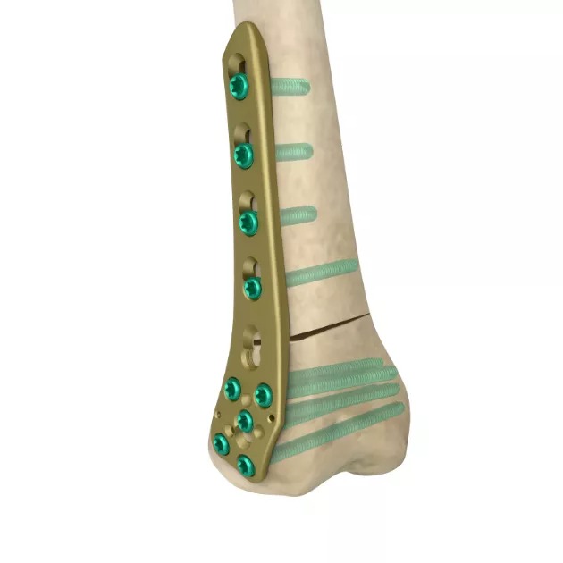 MR-OSTO Distal Lateral Femoral Plate
