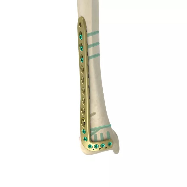 LCP Distal Anterolateral Tibial Plate