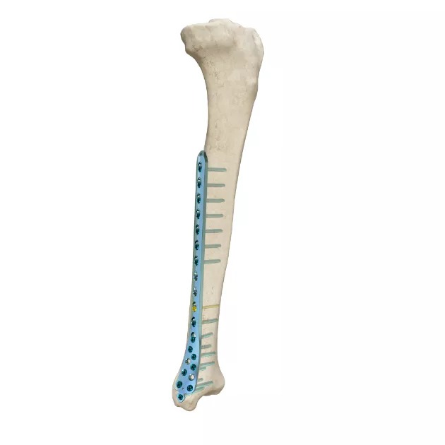LCP Distal Medial Tibial Plate