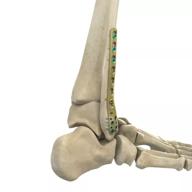 LCP Distal Lateral Fibular Plate
