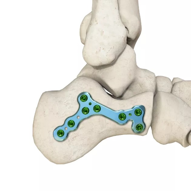MR-LISS Calcaneal LCP, B