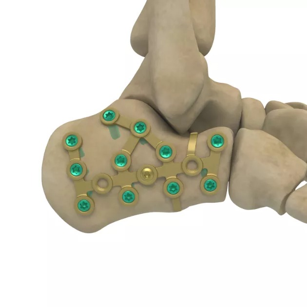 Calcaneal Locking Plate
