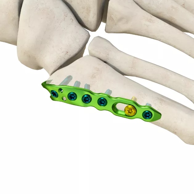 MR-Fifth Metatarsal Locking Plate, TC4