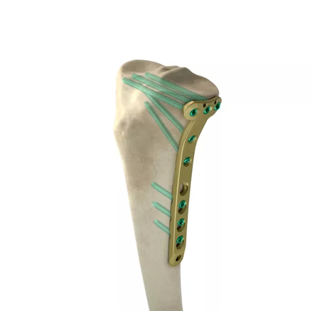 LCP Proximal Medial Tibial Plate 3.5 _01