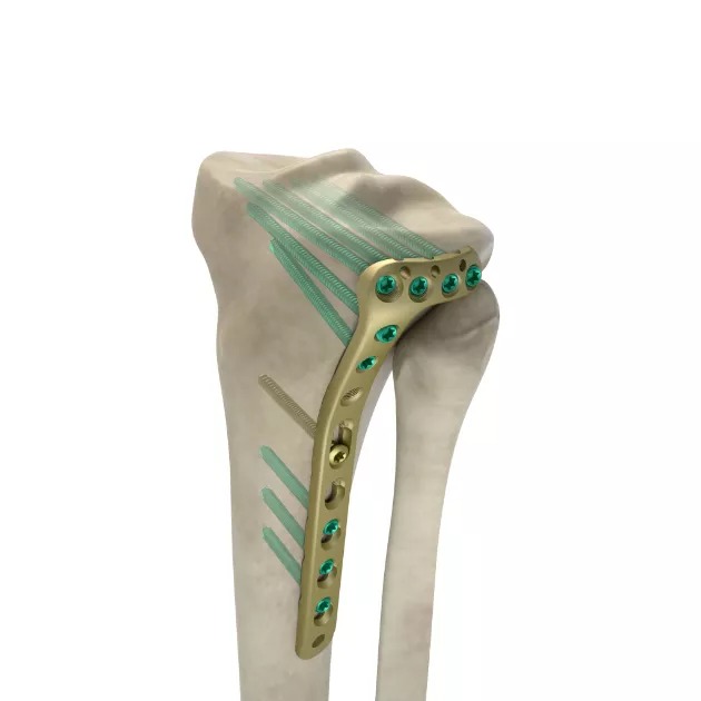 LCP Proximal Tibial Plate 3.5, low bend 01