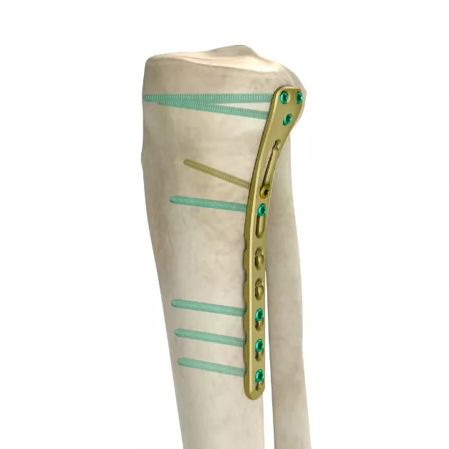 LCP Proximal Posteromedial Tibial Plate01