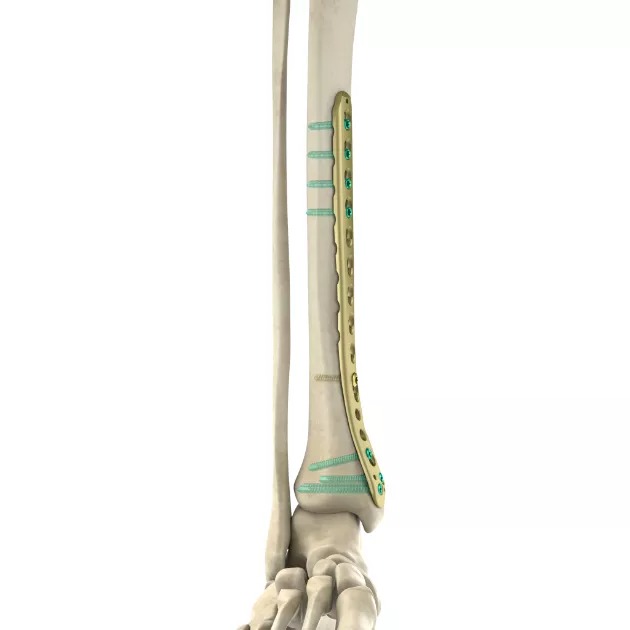 LCP Low Bend Distal Medial Tibial Plate01