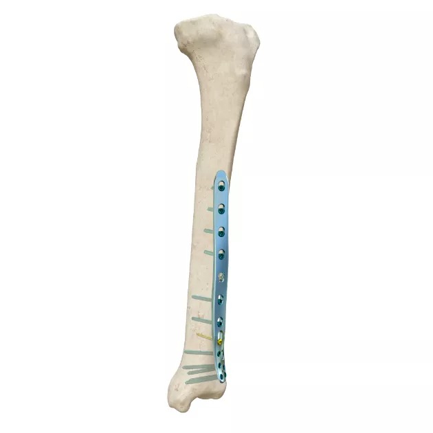 Distal Lateral Tibial Locking Plate 01