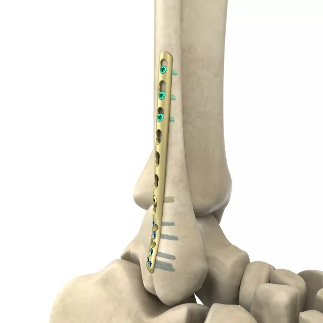 LCP Distal Posterolateral Fibular Plate 01