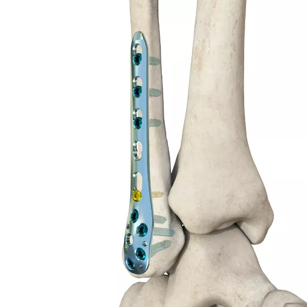 LCP Distal Lateral Fibular Plate 02