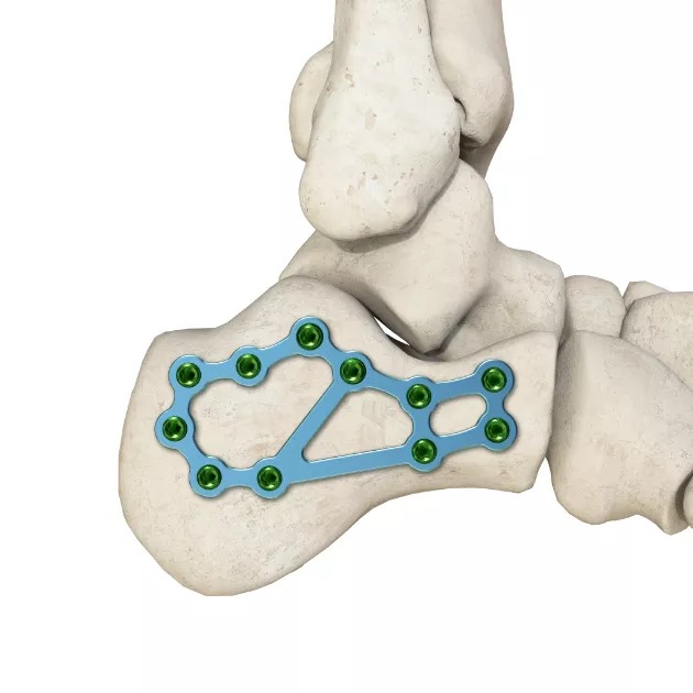 MR-Circular Calcaneal LCP 01