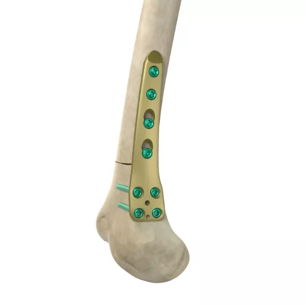 MR-OSTO Distal Medial Femoral Plate 001