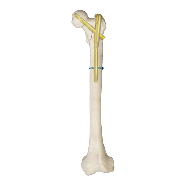 MR-IM Femoral Nail