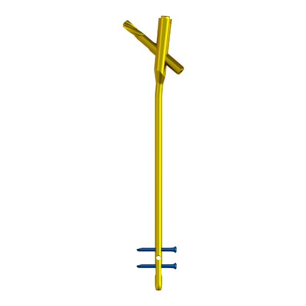 MR-IM Femoral Nail 01