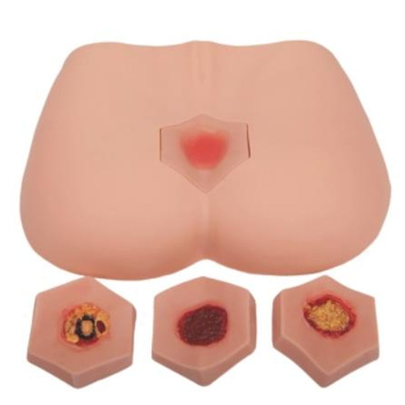 10B Stage Decubitus Ulcer Care Model
