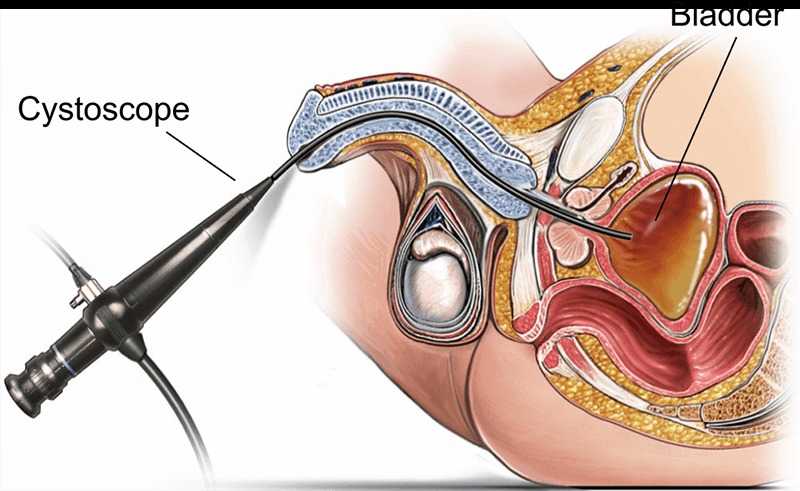 Cystoscopy System